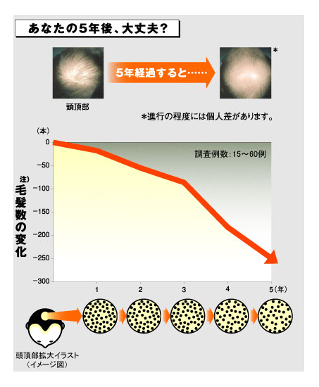 AGA毛髪数の変化