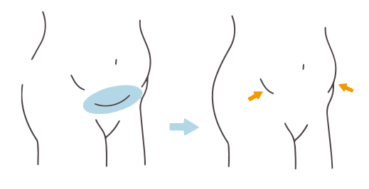 腹部：1箇所のみの施術の図