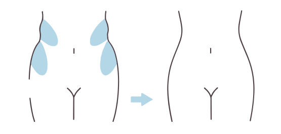 わき腹・腰：2箇所の施術の図