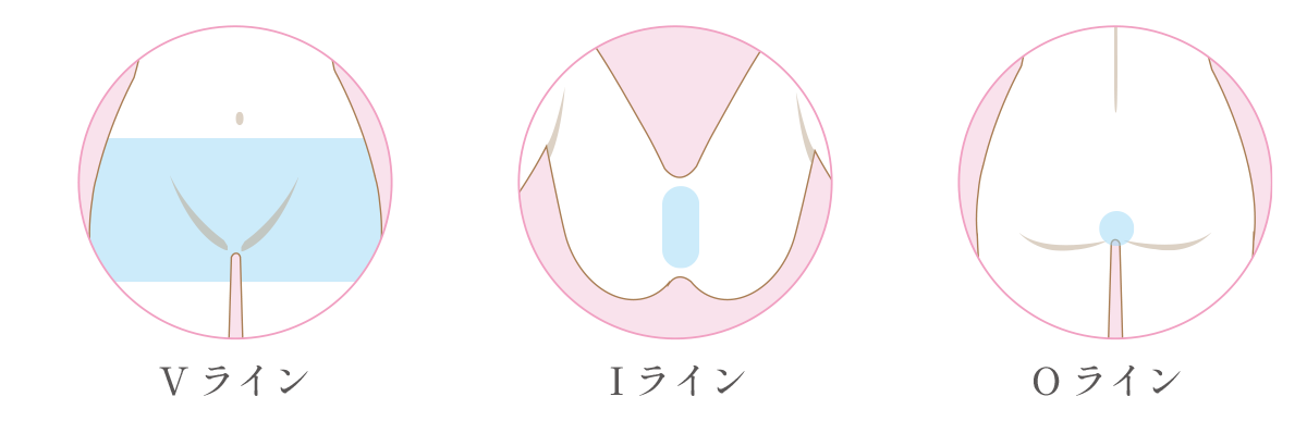 脱毛範囲のイラスト