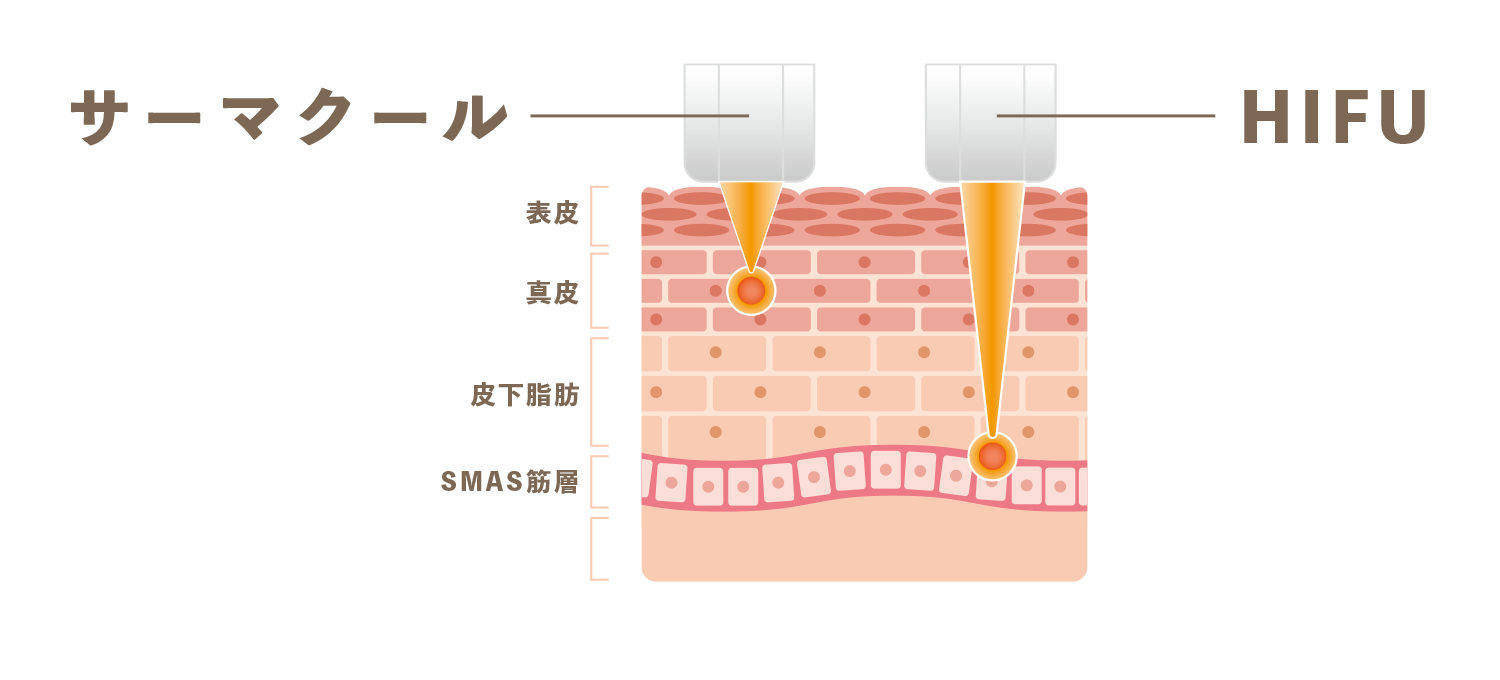 HIFUとサーマクールの違い