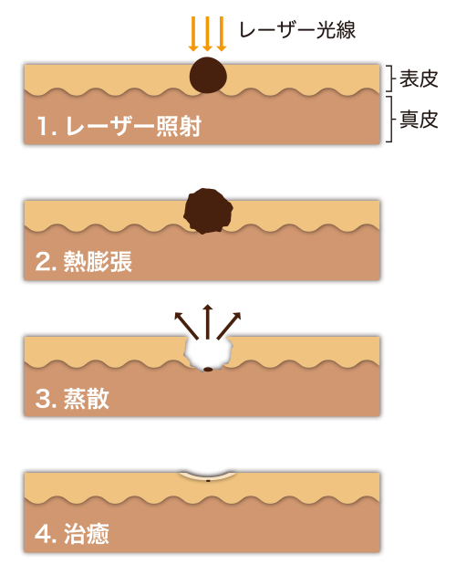 レーザー照射のイメージ図